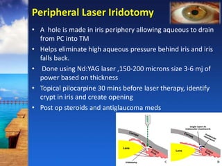 Peripheral Laser Iridotomy
• A hole is made in iris periphery allowing aqueous to drain
from PC into TM
• Helps eliminate high aqueous pressure behind iris and iris
falls back.
• Done using Nd:YAG laser ,150-200 microns size 3-6 mj of
power based on thickness
• Topical pilocarpine 30 mins before laser therapy, identify
crypt in iris and create opening
• Post op steroids and antiglaucoma meds
 