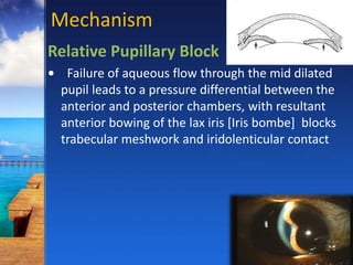Mechanism
Relative Pupillary Block
• Failure of aqueous flow through the mid dilated
pupil leads to a pressure differential between the
anterior and posterior chambers, with resultant
anterior bowing of the lax iris [Iris bombe] blocks
trabecular meshwork and iridolenticular contact
 