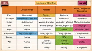Causes of Red Eye
Conjunctivitis Keratitis Iritis
Acute Congestive
Glaucoma
Pain Discomfort Stitching Dull ache Bursting
Discharge Mucopurulent / Purulent Lacrimation Lacrimation Lacrimation
Vision slight blurred Marked diminution Moderately affected Marked diminution
IOP Normal Normal or high Normal, high or low Very high
Pupil Normal +/- miosis Miosis Mid dilated, fixed
Conjunctiva Conjunctival injection Ciliary injection Ciliary injection Ciliary injection
Cornea Normal Ulcer KPs Edema
AC Normal
Activity
Hypopyon
Activity
Hypopyon
Shallow
Iris Normal Muddy Muddy Congested
 