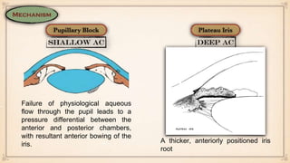 Failure of physiological aqueous
flow through the pupil leads to a
pressure differential between the
anterior and posterior chambers,
with resultant anterior bowing of the
iris.
A thicker, anteriorly positioned iris
root
 