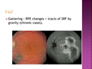 Pachychoroid | PPTX