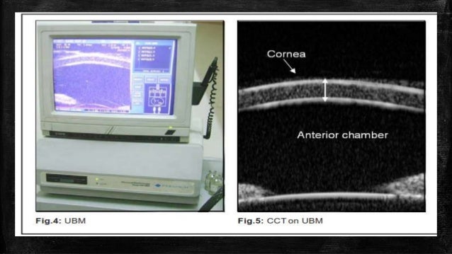Pachymetry