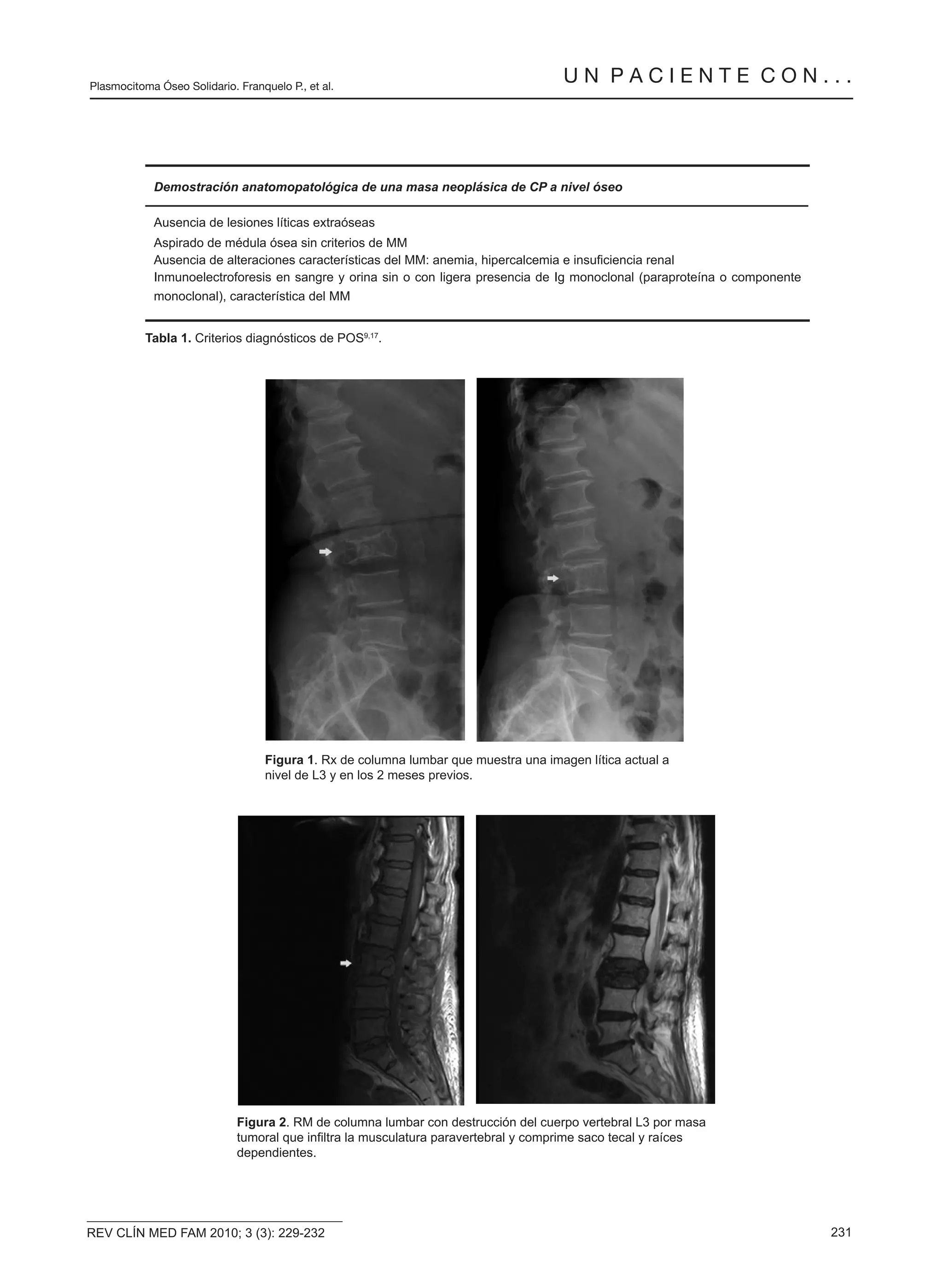 Plasmocitoma solitario | PDF