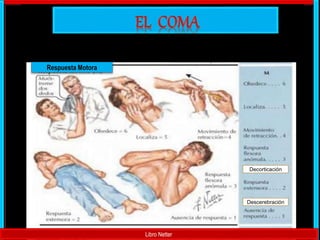 Libro Netter
Respuesta Motora
Decorticación
Descerebración
 
