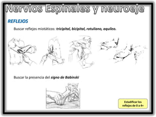 REFLEJOS
Buscar reflejos miotáticos: tricipital, bicipital, rotuliano, aquíleo.

Buscar la presencia del signo de Babinski

Estadificar los
reflejos de 0 a 4+

 