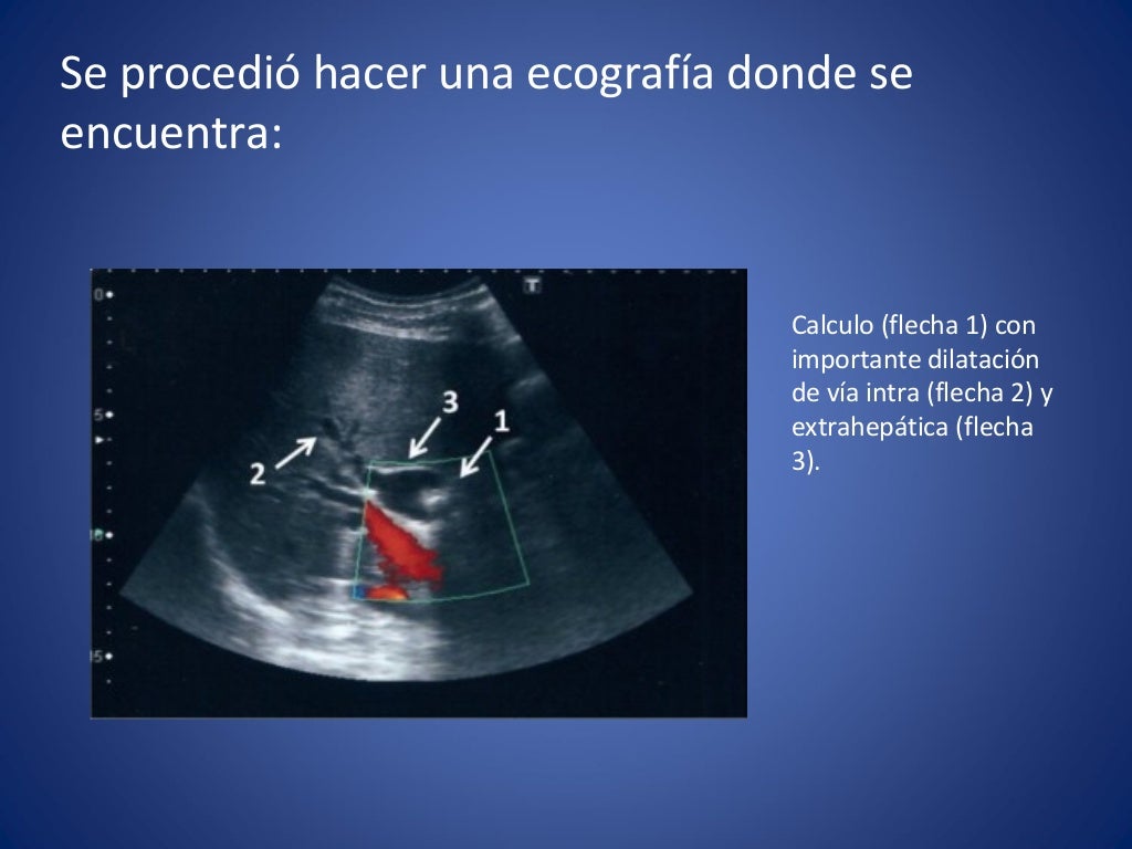 Paciente con ictericia y dolor en hipocondrio derecho