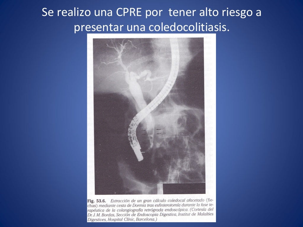 Paciente con ictericia y dolor en hipocondrio derecho