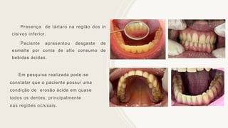 Presença de tártaro na região dos in
cisivos inferior.
Paciente apresentou desgaste de
esmalte por conta de alto consumo de
bebidas ácidas.
Em pesquisa realizada pode-se
constatar que o paciente possui uma
condição de erosão ácida em quase
todos os dentes, principalmente
nas regiões oclusais.
 