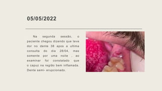05/05/2022
Na segunda sessão, o
paciente chegou dizendo que teve
dor no dente 38 apos a ultima
consulta do dia 28/04, mas
somente por uma noite , ao
examinar foi constatado que
o capuz na região bem inflamada.
Dente semi- erupcionado.
 