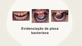 Evidenciação de placa
bacteriana
 