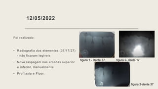 12/05/2022
Foi realizado:
• Radiografia dos elementes (37/17/27)
- não ficaram legiveis
• Nova raspagem nas arcadas superior
e inferior, manualmente
• Profilaxia e Fluor.
figura 1 - Dente 37 figura 2- dente 17
figura 3-dente 37
 