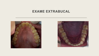 EXAME EXTRABUCAL
 