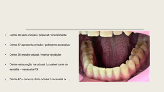 • Dente 38 semi-incluso / possivel Pericoronarite
• Dente 37 apresenta erosão / polimento excessivo
• Dente 36 erosão oclusal / resina vestibular
• Dente restauração na oclusal / possivel carie de
esmalte – necessita RX
• Dente 47 – carie na disto oclusal / necessita rx
 