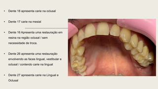 • Dente 18 apresenta carie na oclusal
• Dente 17 carie na mesial
• Dente 16 Apresenta uma restauração em
resina na região oclusal / sem
necessidade de troca.
• Dente 26 apresenta uma restauração
envolvendo as faces lingual, vestibular e
oclusal / contendo carie na lingual
• Dente 27 apresenta carie na Lingual e
Oclusal
 