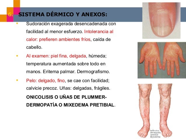 Paciente Hipertiroidismo Casooooooooo