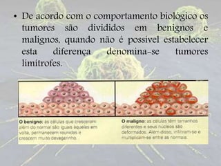 • De acordo com o comportamento biológico os
tumores são divididos em benignos e
malignos, quando não é possível estabelecer
esta diferença denomina-se tumores
limítrofes.
 