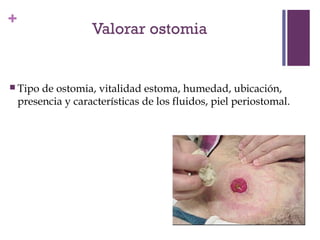 + 
 Tipo de ostomia, vitalidad estoma, humedad, ubicación, 
presencia y características de los fluidos, piel periostomal. 
 