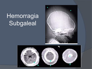 Hemorragia
 Subgaleal
 
