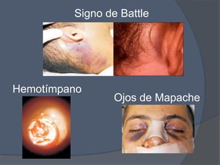 Signo de Battle




Hemotímpano
                Ojos de Mapache
 