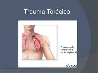 Trauma Torácico
 