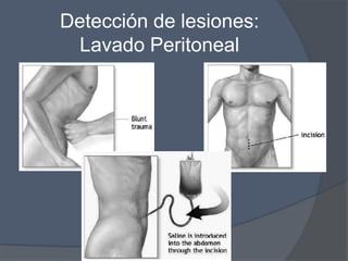 Detección de lesiones:
 Lavado Peritoneal
 