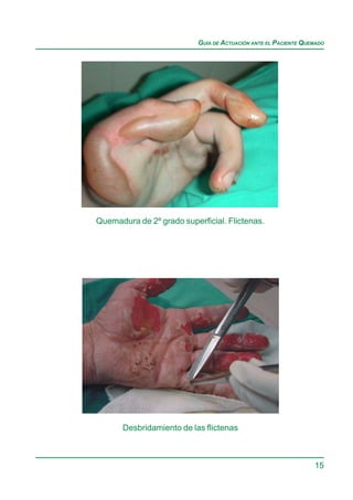 GUÍA DE ACTUACIÓN ANTE EL PACIENTE QUEMADO




Quemadura de 2º grado superficial. Flictenas.




       Desbridamiento de las flictenas



                                                                 15
 