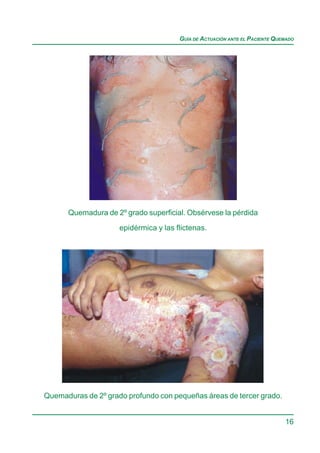 GUÍA DE ACTUACIÓN ANTE EL PACIENTE QUEMADO




      Quemadura de 2º grado superficial. Obsérvese la pérdida
                     epidérmica y las flictenas.




Quemaduras de 2º grado profundo con pequeñas áreas de tercer grado.


                                                                             16
 