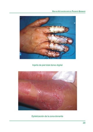 GUÍA DE ACTUACIÓN ANTE EL PACIENTE QUEMADO




Injerto de piel total dorso digital




Epitelización de la zona donante

                                                             20
 