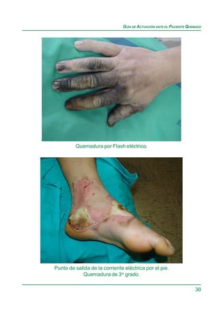 GUÍA DE ACTUACIÓN ANTE EL PACIENTE QUEMADO




         Quemadura por Flash eléctrico.




Punto de salida de la corriente eléctrica por el pie.
            Quemadura de 3er grado.

                                                                     30
 