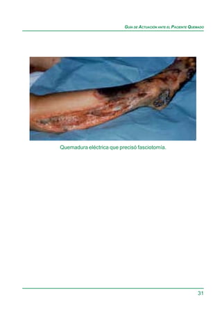 GUÍA DE ACTUACIÓN ANTE EL PACIENTE QUEMADO




Quemadura eléctrica que precisó fasciotomía.




                                                                31
 