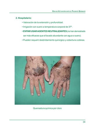 GUÍA DE ACTUACIÓN ANTE EL PACIENTE QUEMADO


2. Hospitalario:

      • Valoración de la extensión y profundidad.
      • Irrigación con suero a temperatura corporal de 37º.

      • EVITAR USAR AGENTES NEUTRALIZANTES (no han demostrado

       ser más eficaces que el lavado abundante con agua o suero).
      • Pueden requerir desbridamiento quirúrgico y cobertura cutánea.




                   Quemadura química por cloro




                                                                           34
 