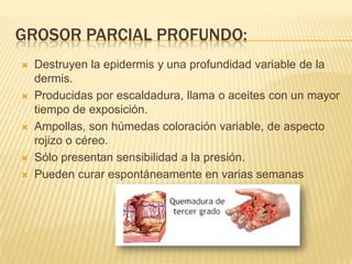 GROSOR PARCIAL PROFUNDO:
   Destruyen la epidermis y una profundidad variable de la
    dermis.
   Producidas por escaldadura, llama o aceites con un mayor
    tiempo de exposición.
   Ampollas, son húmedas coloración variable, de aspecto
    rojizo o céreo.
   Sólo presentan sensibilidad a la presión.
   Pueden curar espontáneamente en varias semanas
 
