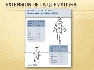 EXTENSIÓN DE LA QUEMADURA
 