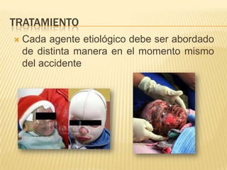 TRATAMIENTO
   Cada agente etiológico debe ser abordado
    de distinta manera en el momento mismo
    del accidente
 