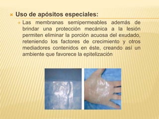    Uso de apósitos especiales:
       Las membranas semipermeables además de
        brindar una protección mecánica a la lesión
        permiten eliminar la porción acuosa del exudado,
        reteniendo los factores de crecimiento y otros
        mediadores contenidos en éste, creando así un
        ambiente que favorece la epitelización
 