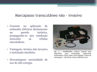 Marcapasso transcutâneo não - invasivo
• Consiste na aplicação de
estímulos elétricos diretamente
na parede torácica,
propagando-se por condução
muscular as células
miocárdicas.
• Vantagem: técnica não invasiva
e instalação imediata.
• Desvantagem: necessidade de
uso de alta energia.
Fig. 4 - Desfibrilador externo manual com
dispositivo para estimulação temporária
transcutânea. Fonte: Melo, Celso Salgado. Temas de
marcapasso – São Paulo: Lemos editorial, 2001.
 