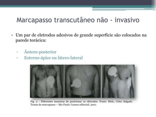 Marcapasso transcutâneo não - invasivo
• Um par de eletrodos adesivos de grande superfície são colocados na
parede torácica:
▫ Ântero-posterior
▫ Esterno-ápice ou látero-lateral
Fig. 5 - Diferentes maneiras de posicionar os eletrodos. Fonte: Melo, Celso Salgado.
Temas de marcapasso – São Paulo: Lemos editorial, 2001.
 