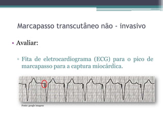 Marcapasso transcutâneo não - invasivo
• Avaliar:
▫ Fita de eletrocardiograma (ECG) para o pico de
marcapasso para a captura miocárdica.
Fonte: google imagens
 