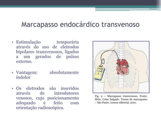 Marcapasso endocárdico transvenoso
• Estimulação temporária
através do uso de eletrodos
bipolares transvenosos, ligados
a um gerados de pulsos
externo.
• Vantagem: absolutamente
indolor
• Os eletrodos são inseridos
através de introdutores
venosos, cujo posicionamento
adequado é feito com
orientação radioscópica.
Fig. 9 – Marcapasso transvenoso. Fonte:
Melo, Celso Salgado. Temas de marcapasso
– São Paulo: Lemos editorial, 2001.
 