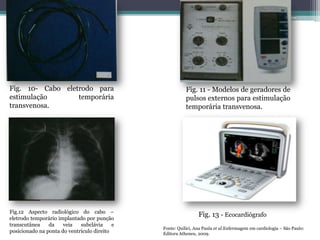 Fig. 10- Cabo eletrodo para
estimulação temporária
transvenosa.
Fig. 11 - Modelos de geradores de
pulsos externos para estimulação
temporária transvenosa.
Fig.12 Aspecto radiológico do cabo –
eletrodo temporário implantado por punção
transcutânea da veia subclávia e
posicionado na ponta do ventrículo direito
Fig. 13 - Ecocardiógrafo
Fonte: Quilici, Ana Paula et al.Enfermagem em cardiologia – São Paulo:
Editora Atheneu, 2009.
 