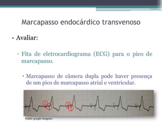 Marcapasso endocárdico transvenoso
• Avaliar:
▫ Fita de eletrocardiograma (ECG) para o pico de
marcapasso.
 Marcapasso de câmera dupla pode haver presença
de um pico de marcapasso atrial e ventricular.
Fonte: google imagens.
 