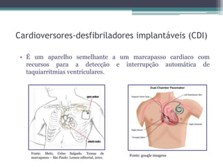 Cardioversores-desfibriladores implantáveis (CDI)
• É um aparelho semelhante a um marcapasso cardíaco com
recursos para a detecção e interrupção automática de
taquiarritmias ventriculares.
Fonte: Melo, Celso Salgado. Temas de
marcapasso – São Paulo: Lemos editorial, 2001.
Fonte: google imagens
 