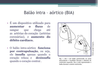 • É um dispositivo utilizado para
aumentar o fluxo de
sangue que chega até
as artérias do coração (artérias
coronárias), e aumento do
débito cardíaco.
• O balão intra-aórtico funciona
por contrapulsação, ou seja,
ele insufla apenas quando o
coração relaxa e desinsufla
quando o coração contrai .
Fonte:googleimagens.
Balão intra – aórtico (BIA)
Fig. 1. Em 1 um balão posicionado na aorta
descendente e insuflado durante a diástole do
ventrículo esquerdo. Em 2 está representado o
balão durante a sístole ventricular.
 