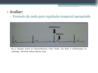 • Avaliar:
▫ Formato da onda para regulação temporal apropriada
Fig 3- Clicagem através do eletrocardiograma. Fonte: Quilici, Ana Paula et al.Enfermagem em
cardiologia – São Paulo: Editora Atheneu, 2009.
 