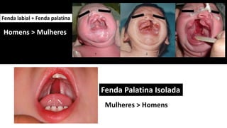 Mulheres > Homens
Homens > Mulheres
Fenda labial + Fenda palatina
Fenda Palatina Isolada
 