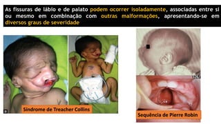 As fissuras de lábio e de palato podem ocorrer isoladamente, associadas entre si
ou mesmo em combinação com outras malformações, apresentando-se em
diversos graus de severidade
Síndrome de Treacher Collins
Sequência de Pierre Robin
 
