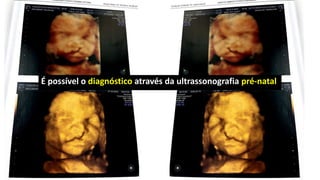 É possível o diagnóstico através da ultrassonografia pré-natal
 