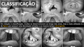 Em relação à classificação, muitas se desenvolveram ao longo dos anos, mas a mais utilizada é a
de Spina por possuir uma denotação simples e ao mesmo tempo abrangente.
CLASSIFICAÇÃO
 