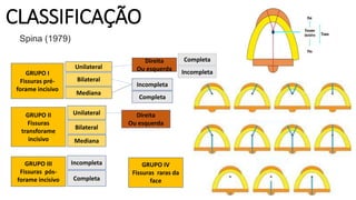 CLASSIFICAÇÃO
Completa
GRUPO I
Fissuras pré-
forame incisivo
Bilateral
Mediana
Unilateral
Incompleta
Direita
Ou esquerda
Completa
Incompleta
GRUPO II
Fissuras
transforame
incisivo
Unilateral
Bilateral
Mediana
GRUPO III
Fissuras pós-
forame incisivo
Incompleta
Completa
Direita
Ou esquerda
GRUPO IV
Fissuras raras da
face
Spina (1979)
 
