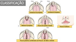 Unilateral Incompleta
Bilateral Completa
Unilateral Completa
Fissura de palato isolada
Fissura palatina combinada com fissura de lábio e alvéolo
CLASSIFICAÇÃO
Fissura mediana
 